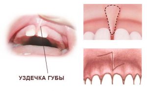 Пластика уздечки губы