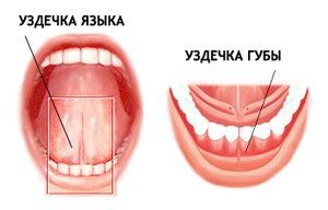 Пластика уздечки губы, языка