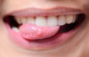 Пластика уздечки губы, языка или преддверия полости рта