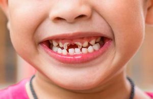 Острая травма зубов у детей