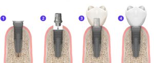 Одномоментная имплантация зуба